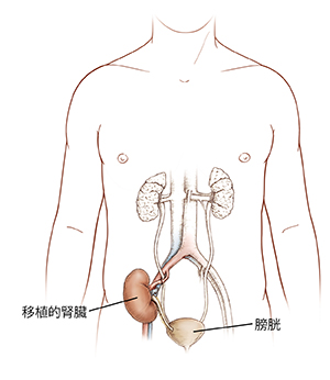 男性身體前視圖，顯示尿道和移植腎臟。