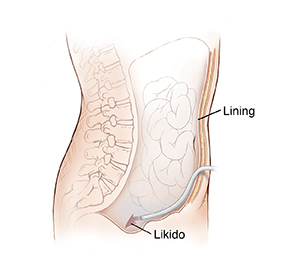 Gilid na kuha ng tiyan na ipinakikita ang catheter na nakapasok sa pinakadingding ng katawan papasok sa abdominal cavity.