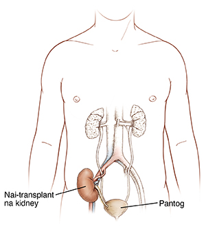 Harapang kuha ng lalaki na ipinakikita ang daluyan ng ihi at na-transplant na kidney.