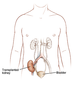 Front view of body showing bladder and transplanted kidney.