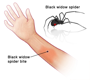 Palm view of hand and forearm showing black widow spider bite on arm. Picture of black widow spider.