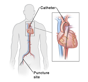 Front view of man with catheter inserted in artery in groin. Inset shows catheter in heart.