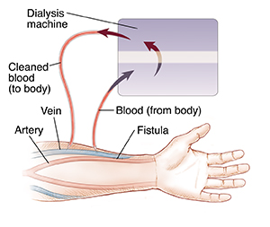 Hemodialysis