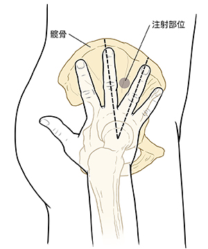 顯示骨盆和腿骨的下半身、髖部和大腿的輪廓側視圖。手指張開且手掌朝下，手掌放在腿骨和臀部的交界處。兩個中指之間圓圈周圍的虛線。