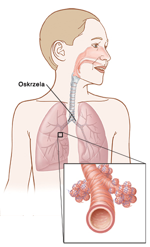 oskrzela