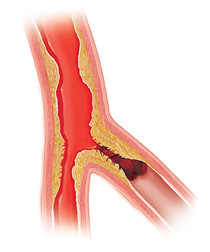 Cross section of artery with plaque buildup and blood clot.