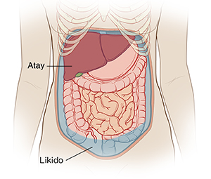 Outline ng tiyan ng babae na ipinakikita ang naiipong likido sa tiyan.
